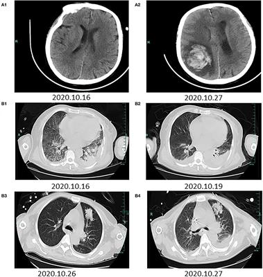 Next Generation Sequencing for Diagnosis of Leptospirosis Combined With Multiple Organ Failure: A Case Report and Literature Review